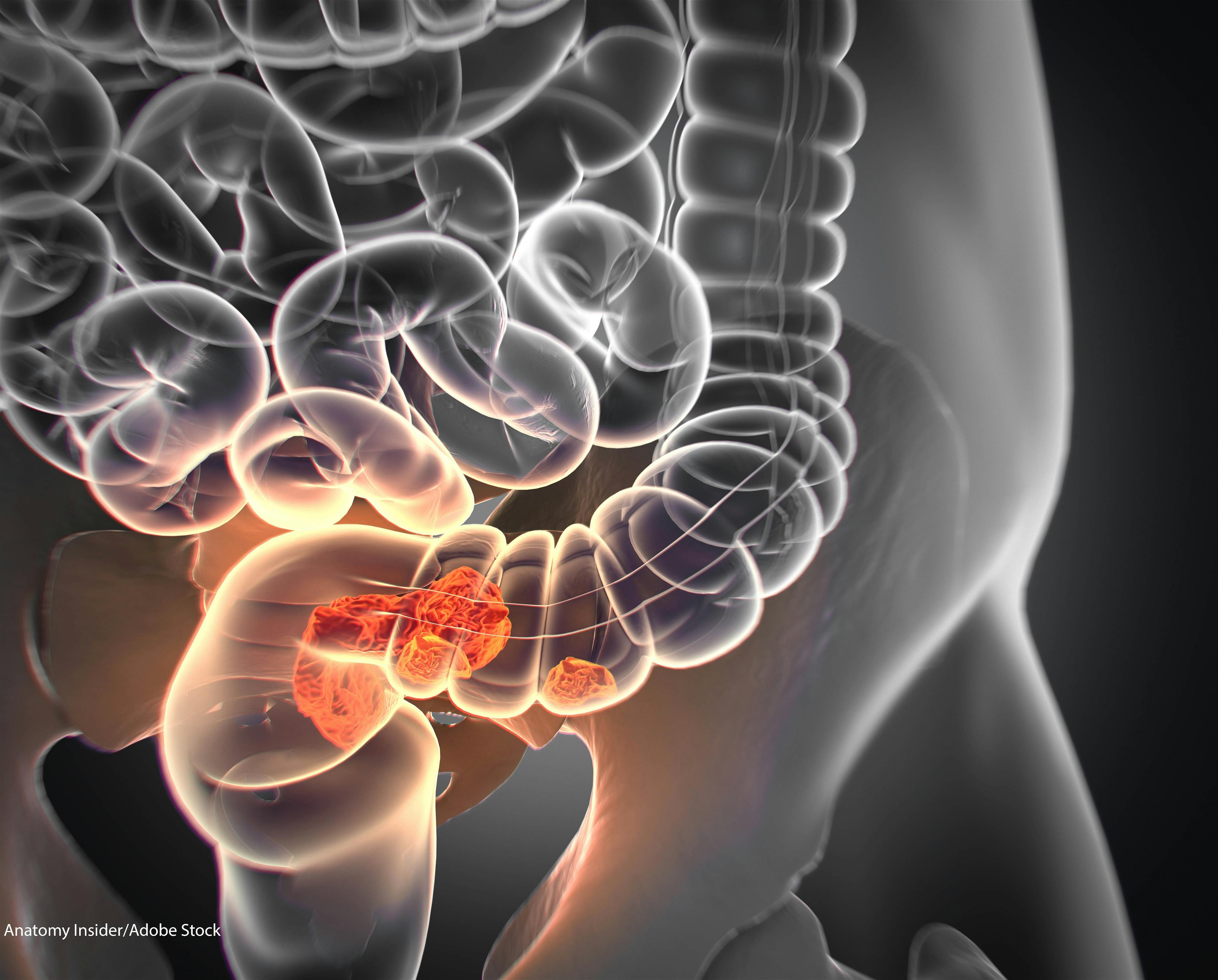 Despite Guidelines, Some with Metastatic Colon Cancer Not Tested for Biomarkers