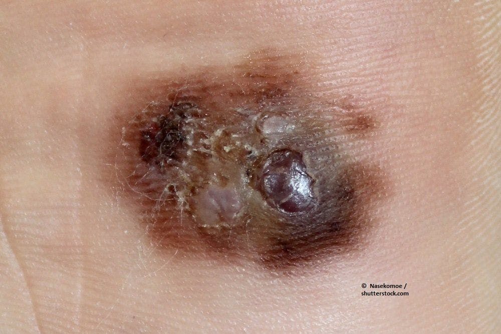 Is Time to First Distant Recurrence of Advanced Melanoma Linked to Survival?