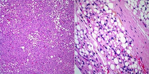 Soft-Tissue Mass in Left Forearm of 38-Year-Old Man