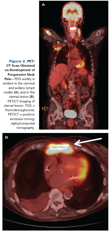 An 84-Year-Old Woman With an Indolent B-Cell Lymphoma