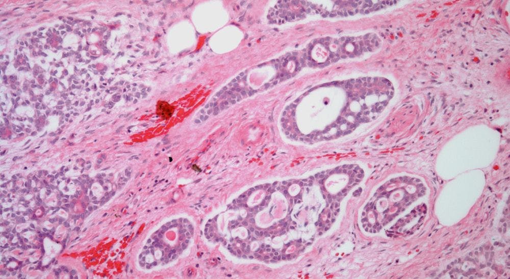 Breast Mass Discovered in 49-Year-Old Patient