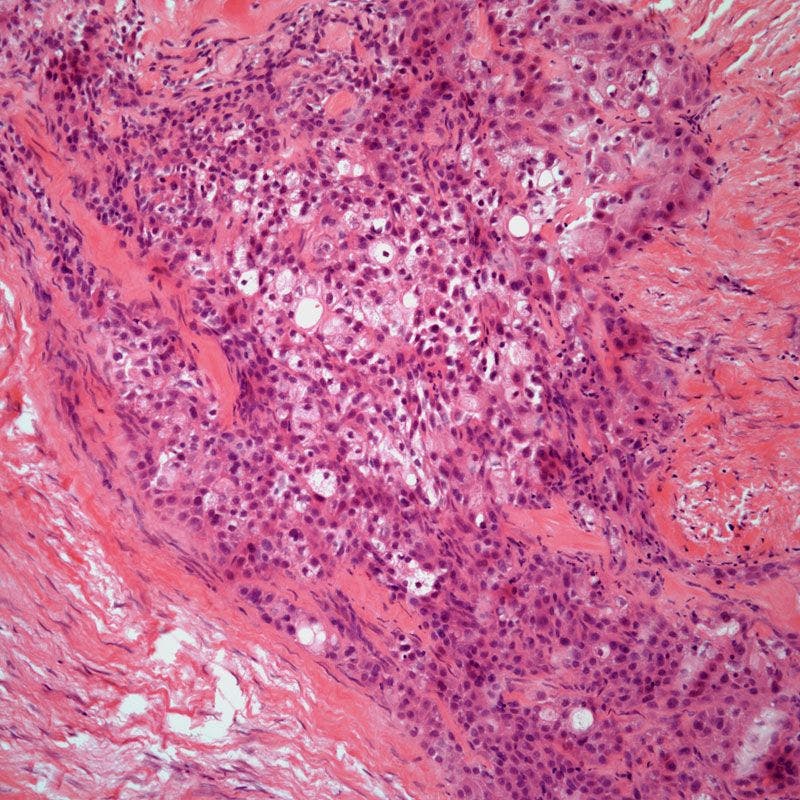 Parotid Gland Tumor in 42-Year-Old Patient