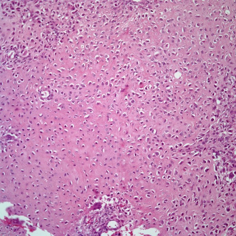 Bone Tumor Found in 27-Year Old Patient
