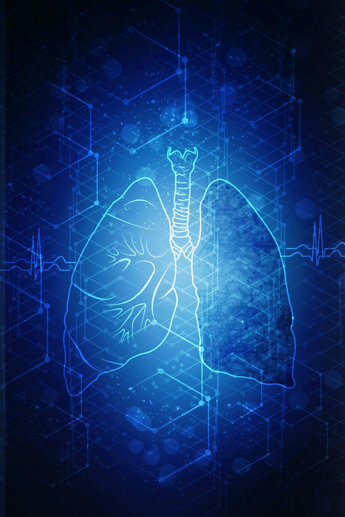 "Iruplinalkib may be a new treatment option for patients with advanced ALK-positive and ALK TKI–naïve NSCLC," according to Runxiang Yang, MD.