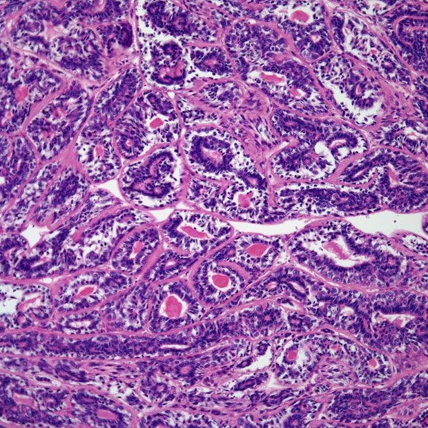 Bronchial Mass Found in 44-Year-Old Patient
