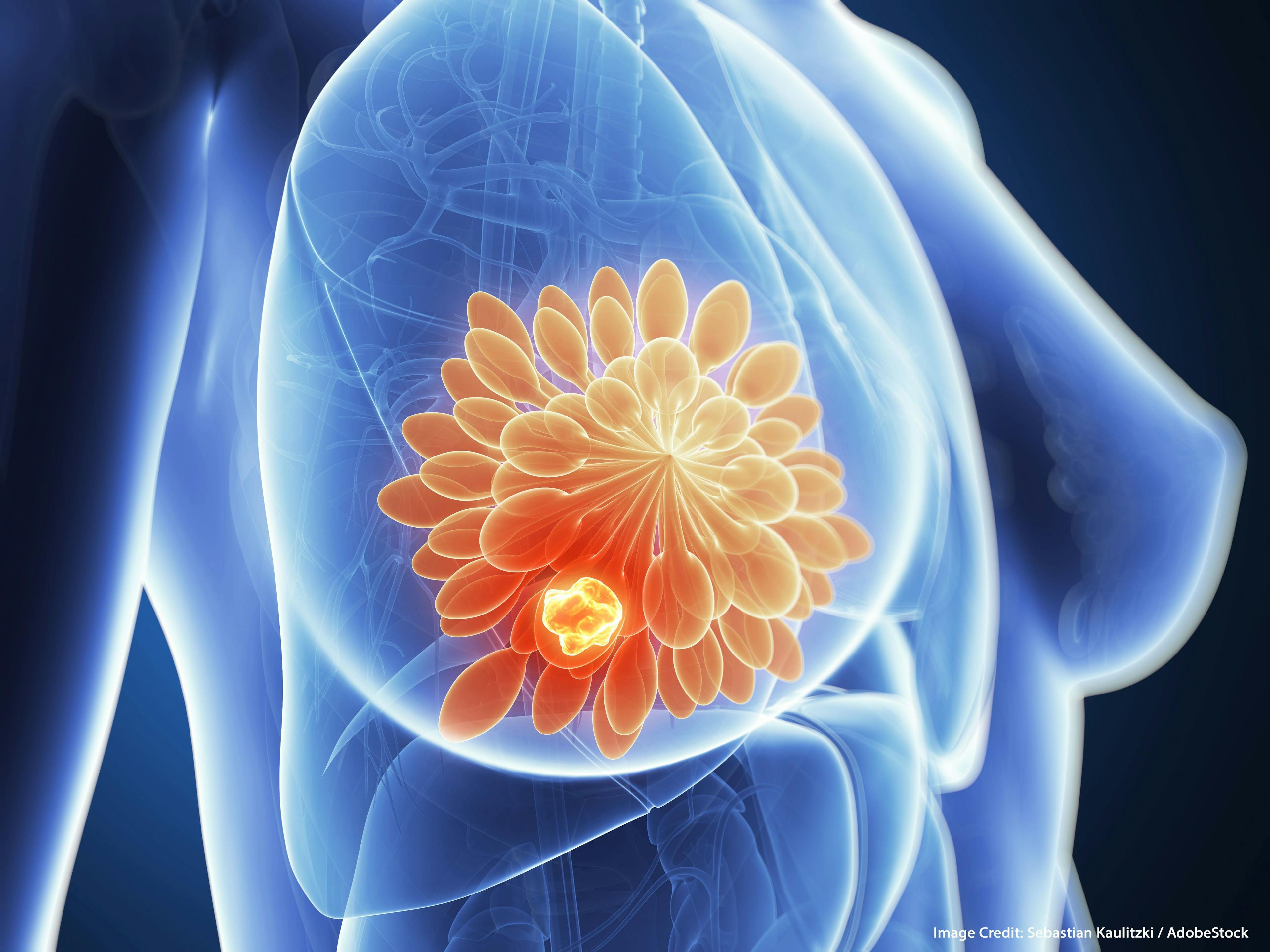 NCCN: Updated Guidelines Reflect Advances, ‘Immunotherapy Era’ for Breast Cancer