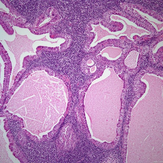 Parotid Mass in 53-Year-Old Patient