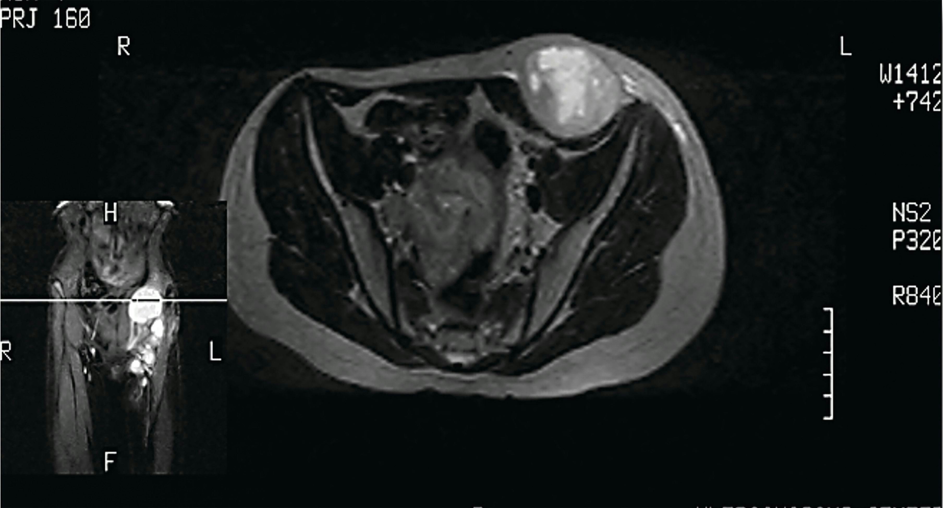FIGURE 3a. The MRI Showed a Grape-Form Mass in the Abdominal Wall.