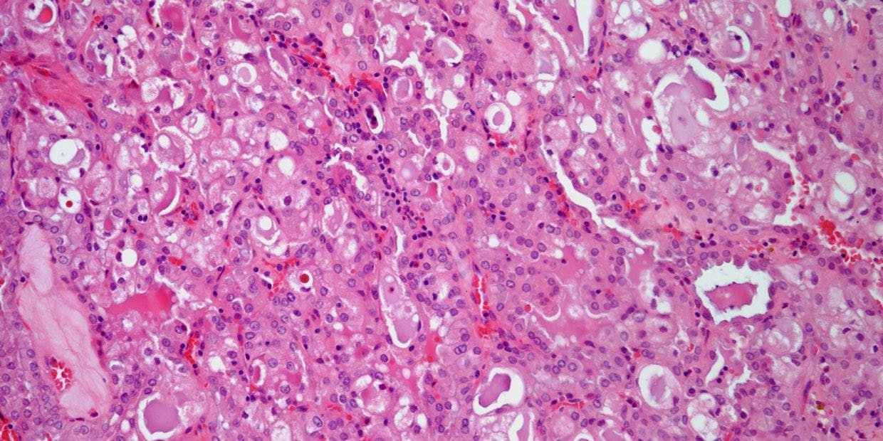 Salivary Gland Lesion in 34-Year-Old Patient
