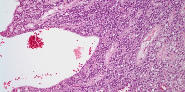 Pancreatic Mass Found in 43-Year-Old Patient