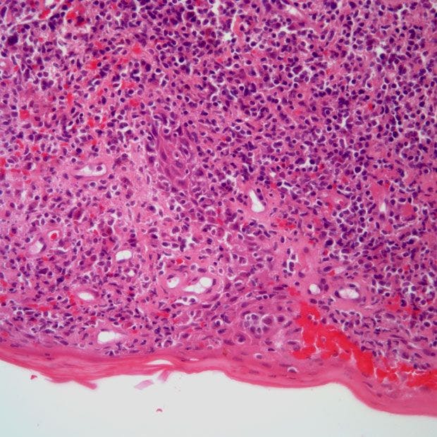 Skin Lesions on the Arms and Abdomen of 62-Year-Old Patient