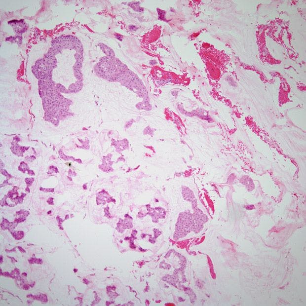 Breast Mass Found in 52-Year-Old Woman