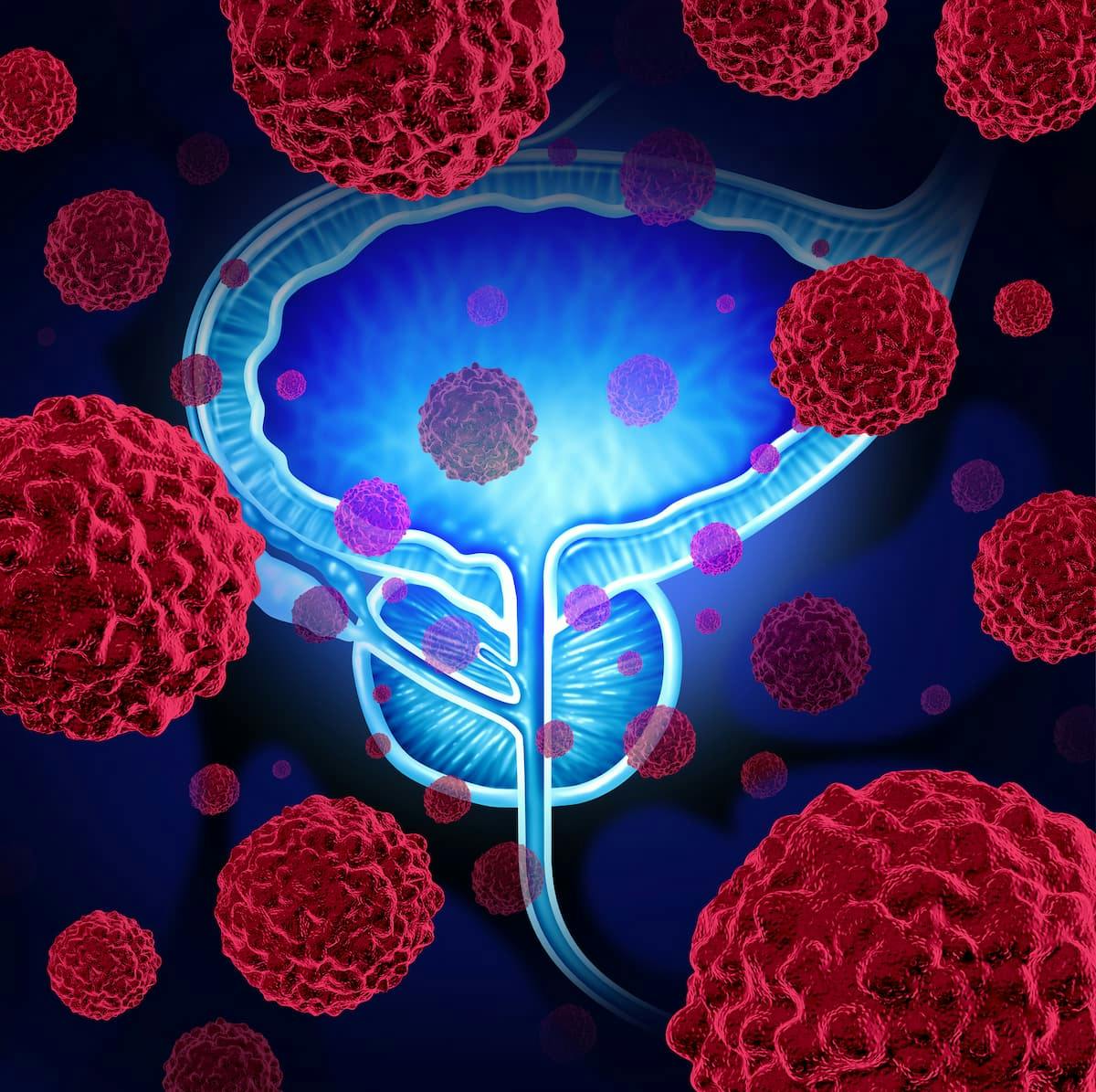 Investigators are currently assessing ARX517 in the phase 1/2 APEX-01 trial (NCT04662580) among patients with metastatic CRPC with disease progression after a minimum of 2 FDA-approved therapies for prostate cancer.