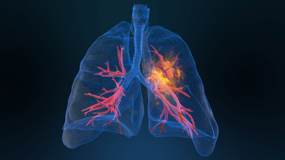 TTFields/SOC Yields Significant Survival Benefit in Metastatic NSCLC | Image Credit: © appledesign - stock.adobe.com.