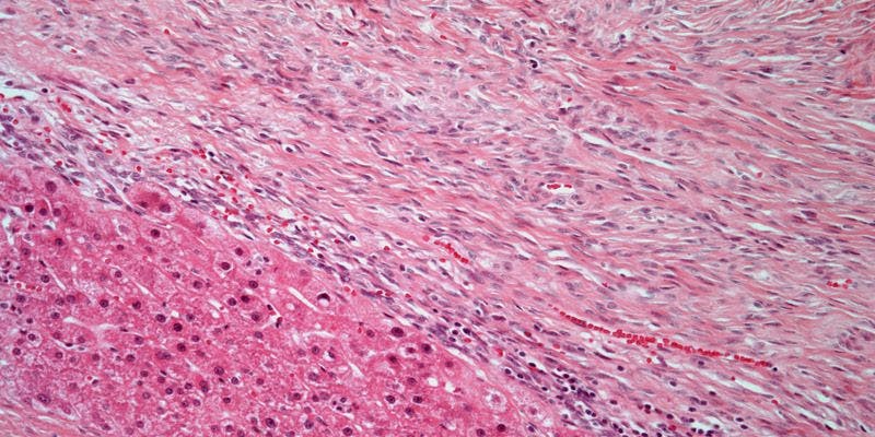 Liver Mass Found in 47-Year-Old Patient