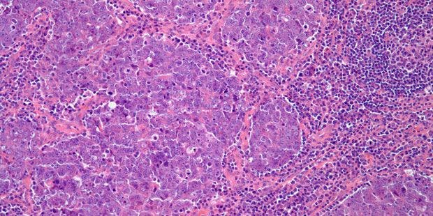 Mass Found in Nasopharynx of 54-Year-Old Patient