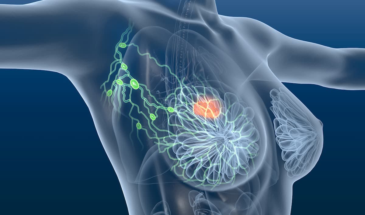 Possible Association Noted Between Tumor Immunogenicity and Survival Outcomes in HR+, HER2+ Early Breast Cancer Following Neoadjuvent T-DM1 De-Escalation