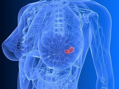 Two Studies Confirm OS Benefit of CDK4/6 Inhibitors in Breast Cancer