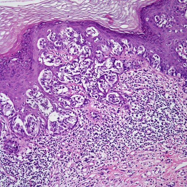 Woman Presents With Vulvar Lesion