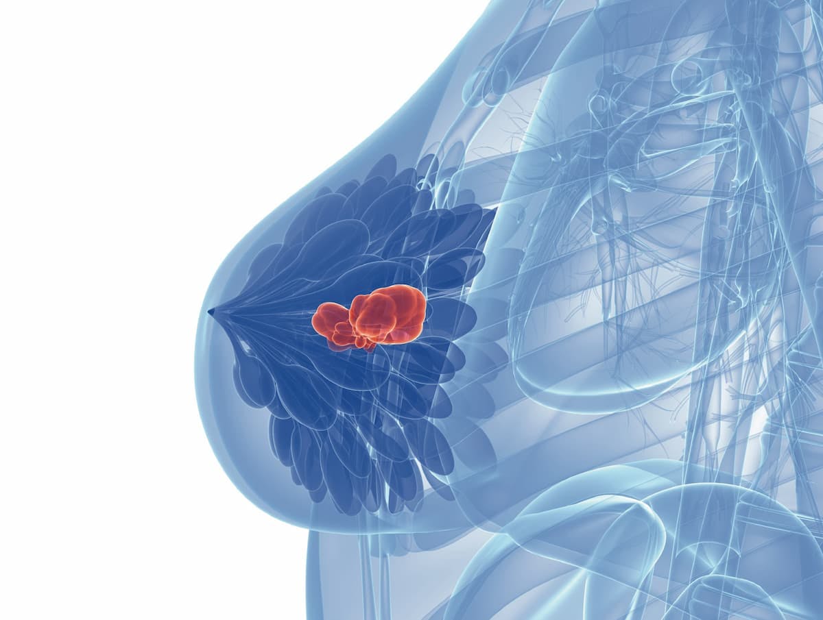 A pooled analysis found that genomic alterations identified through multigene sequencing led to progression-free survival improvements over maintenance chemotherapy for HER2-negative metastatic breast cancer.