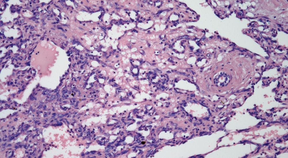 Breast Mass Found in 47-Year-Old Woman