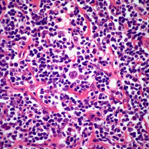 Enlarged Lymph Node in 20-Year-Old Patient