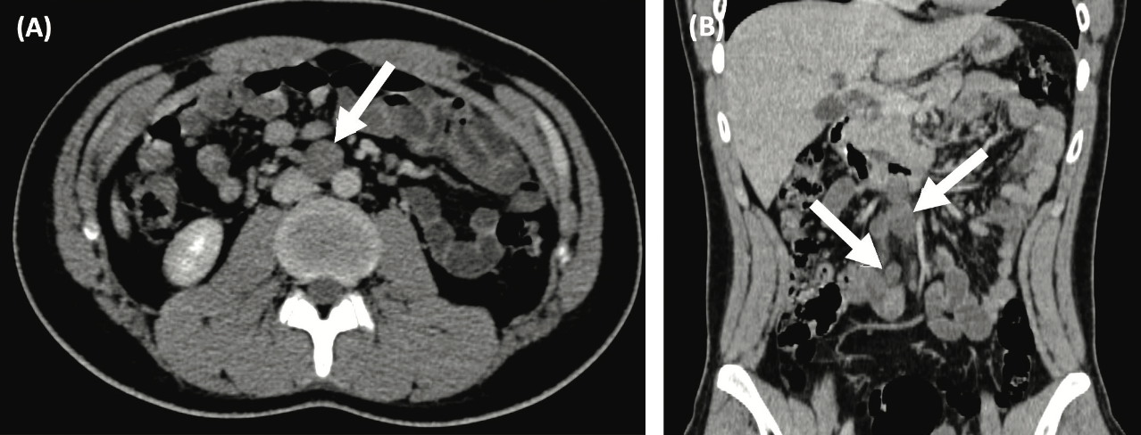Figure 1. Baseline and Follow-up Contrast Enhanced CT scans of a Nonseminomatous Germ Cell Tumor Before and After Systemic Treatment. Baseline axial (A) and coronal (B) CT scans show a 2.07-cm retroperitoneal lymph node enlargement.


