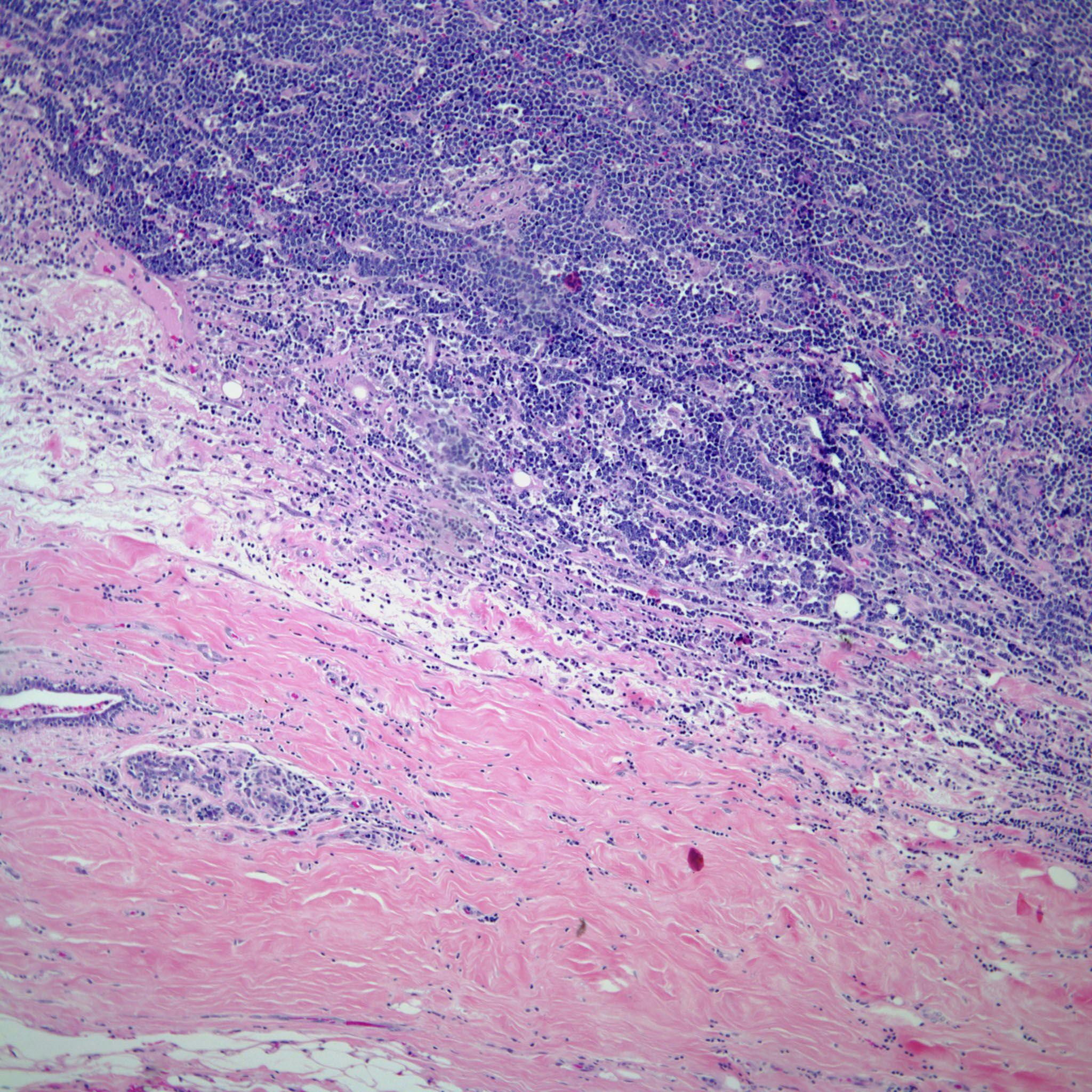 Breast Mass in 46-Year-Old Woman