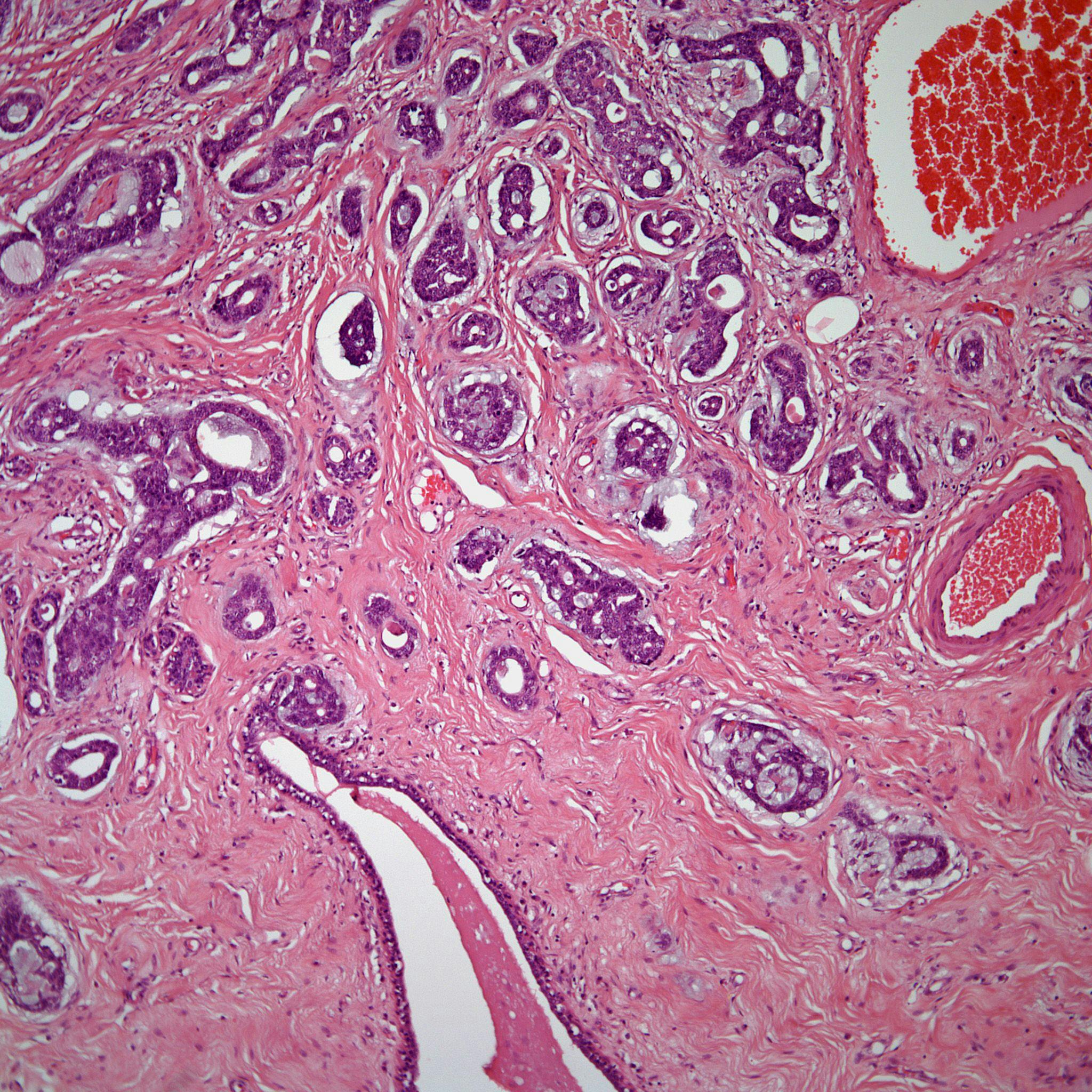 A 42-Year-Old Woman With a Nodule in the Right Breast