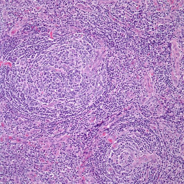 Enlarged Lymph Nodes in 39-Year-Old Patient