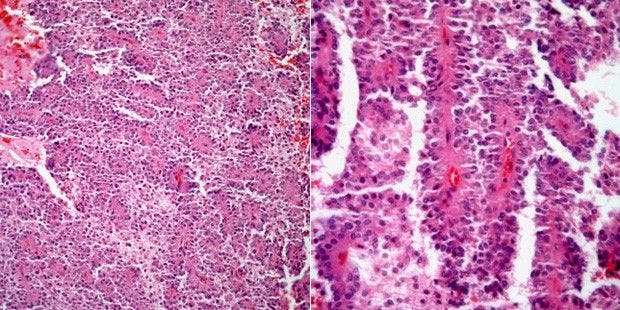 Mass Discovered in the Pancreas of a 28-Year-Old Woman