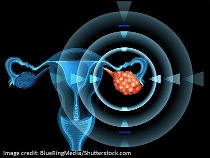 Checkpoint Inhibitor May Help Improve Outcomes in Ovarian Cancer Patients