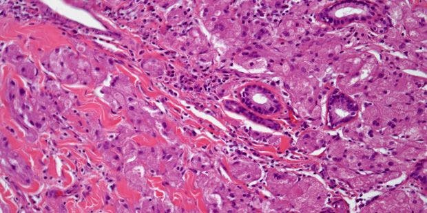 Bronchial Mass Discovered in 47-Year-Old Patient