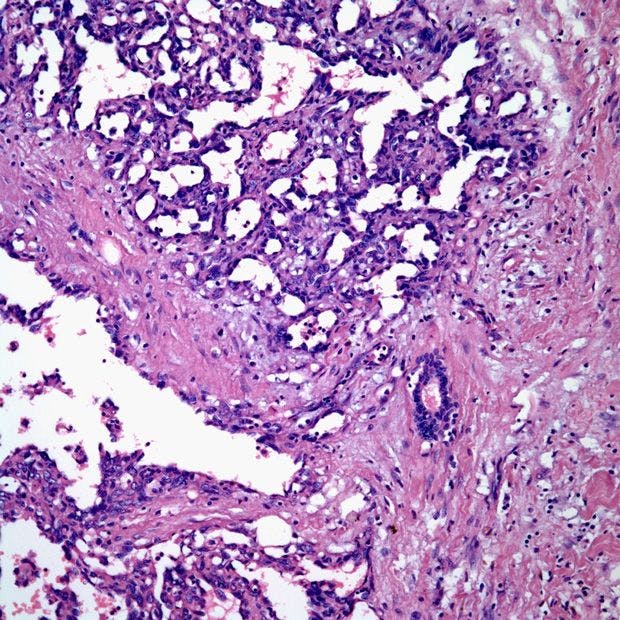 Tumor Found in Breast of 44-Year-Old Woman