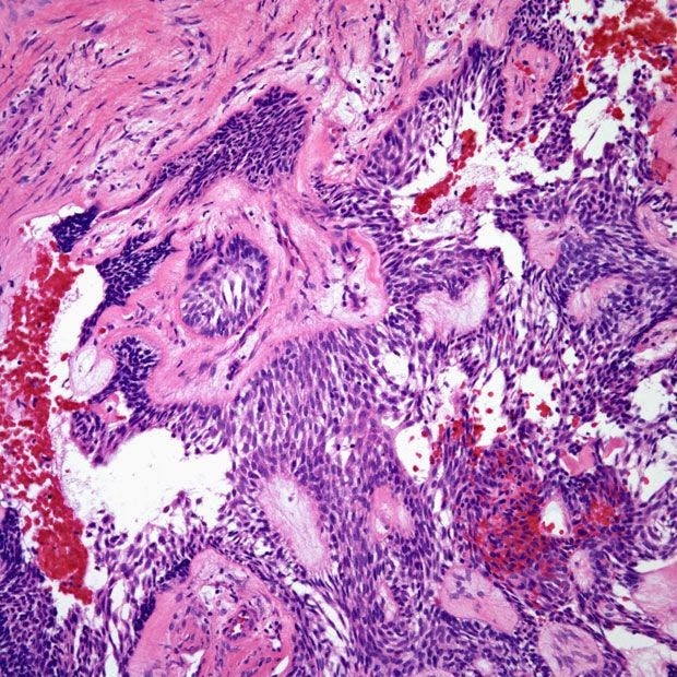 Tumor Discovered in Jaw of 47-Year-Old Patient