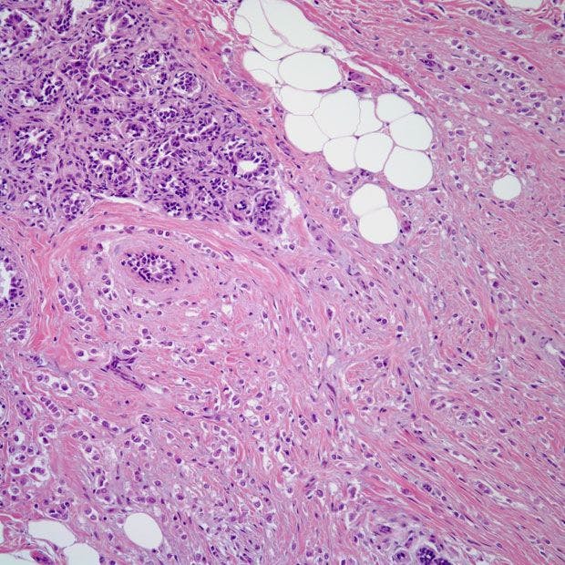 Breast Lesion Found in 53-Year-Old Patient