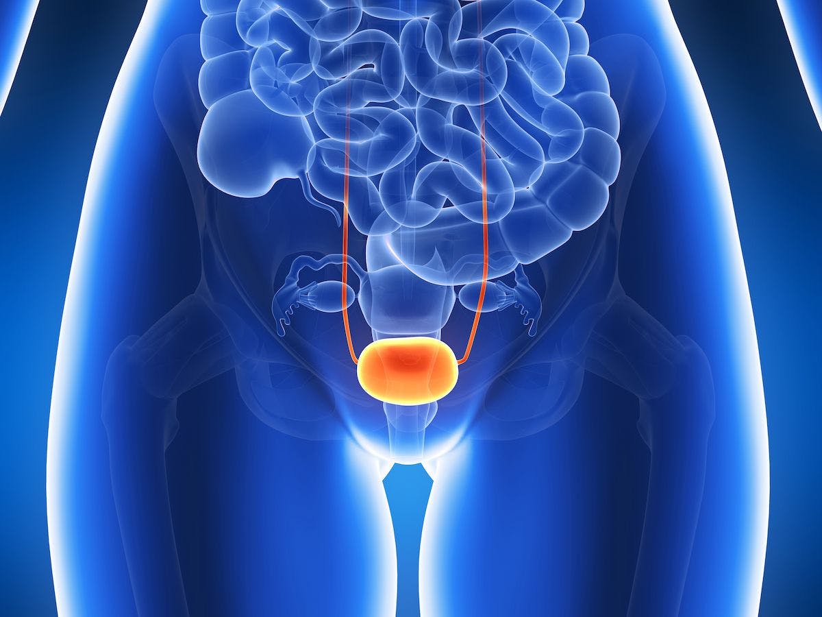 A significant improvement in overall survival was observed in patients with high-risk bladder cancer who achieved radical cystectomy–pentafecta. 