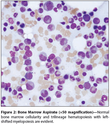 Paraneoplastic Leukocytosis: An Unusual Manifestation of Squamous Cell Carcinoma of the Urinary Bladder