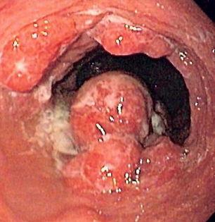 Best to Stage Esophageal Cancer After Neoadjuvant Chemo