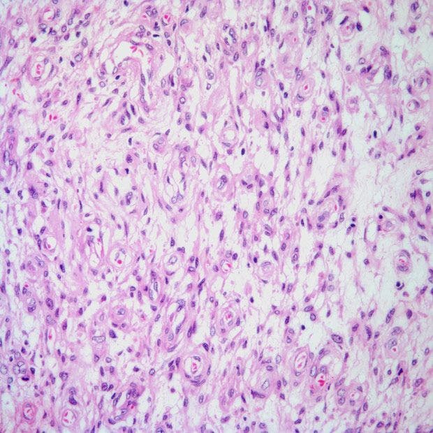 Thigh Mass Found in 43-Year-Old Patient