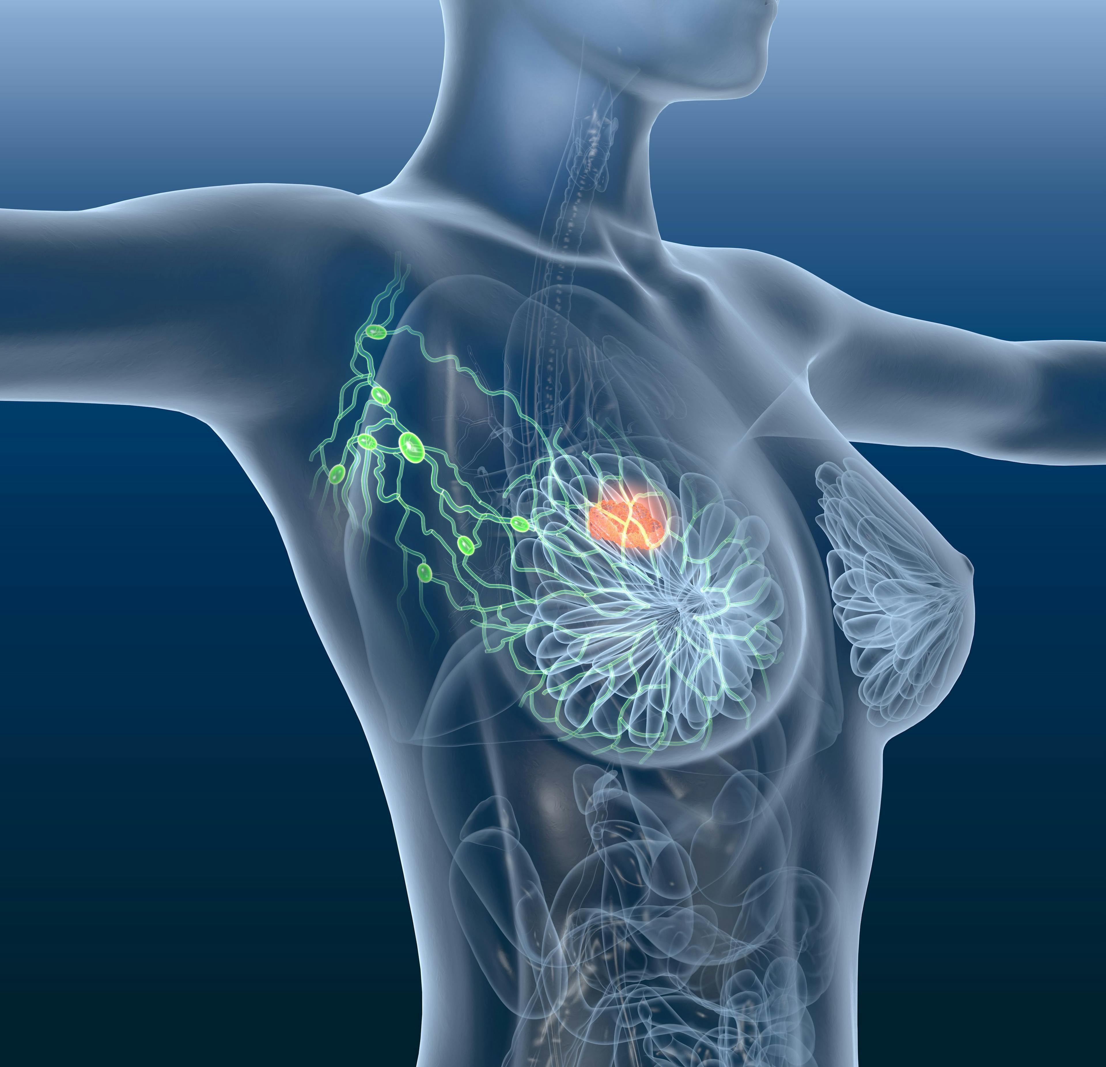 Breast cancer risk was estimated among survivors of pediatric cancer who were treated with chest radiation with a newly developed and validated breast cancer risk prediction model.