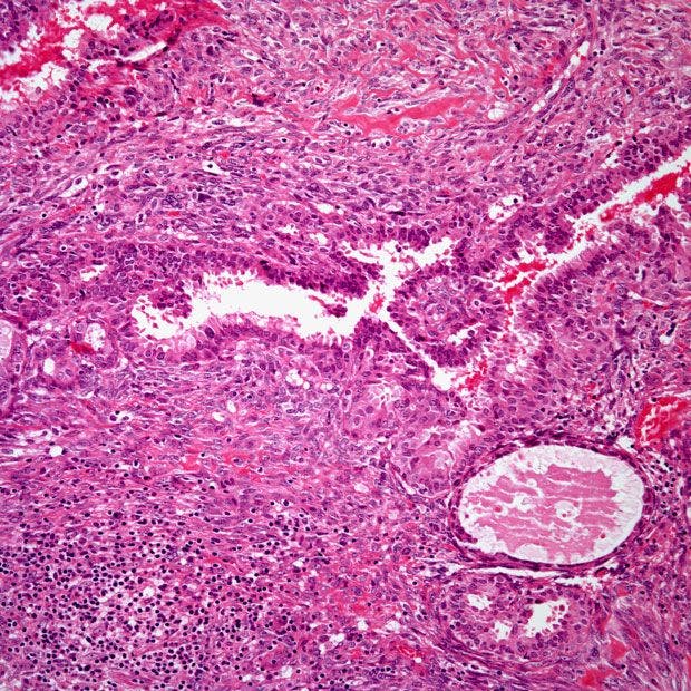 Mass Found in Breast of 43-Year-Old Woman