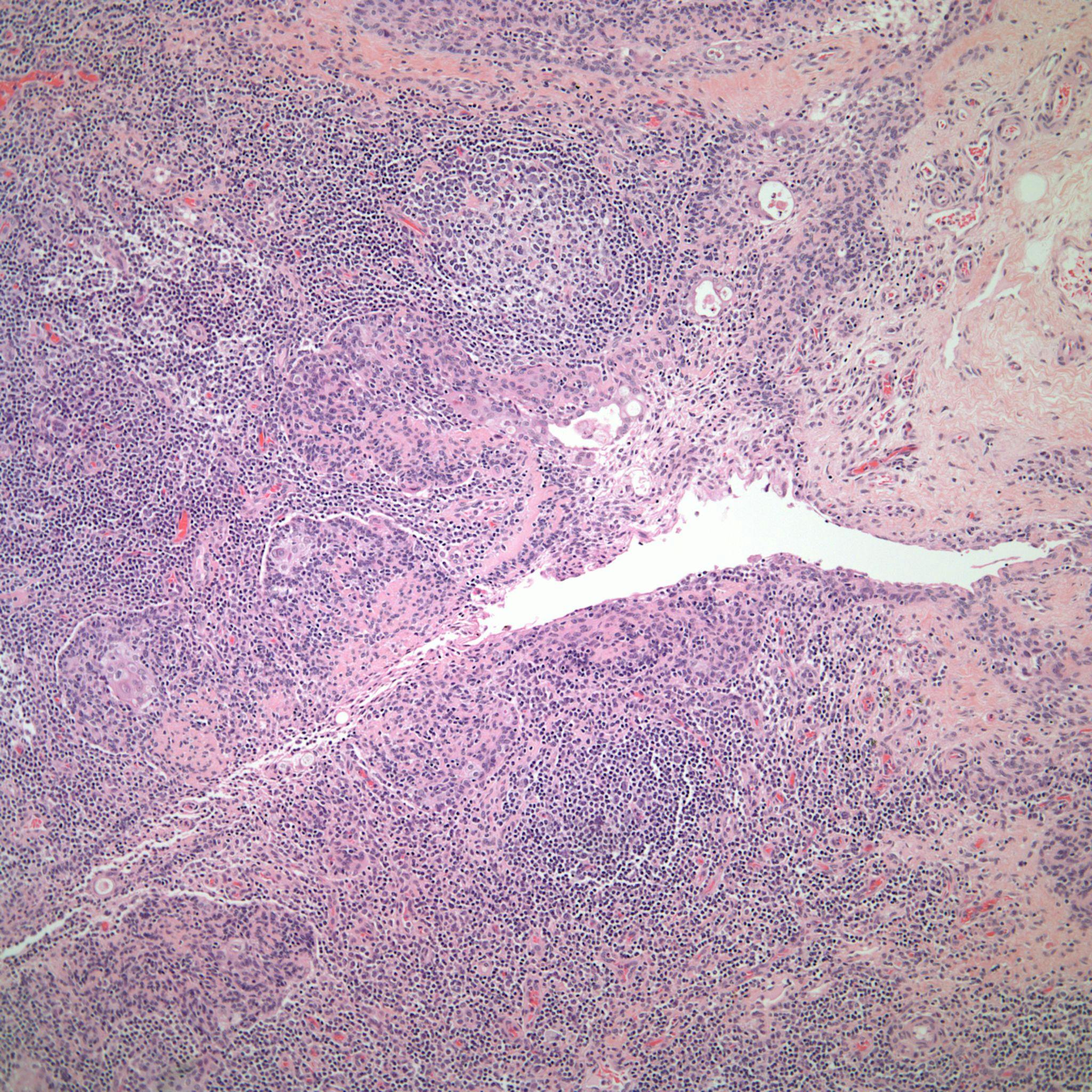 A 35-Year-Old Woman with Dyspnea