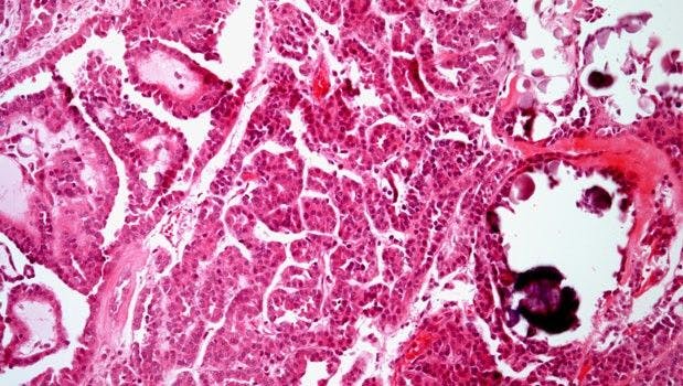 Right Kidney Mass Found in 52-Year-Old Patient