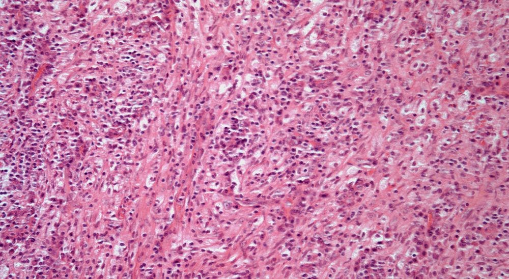 Breast Mass Discovered in 43-Year-Old Woman