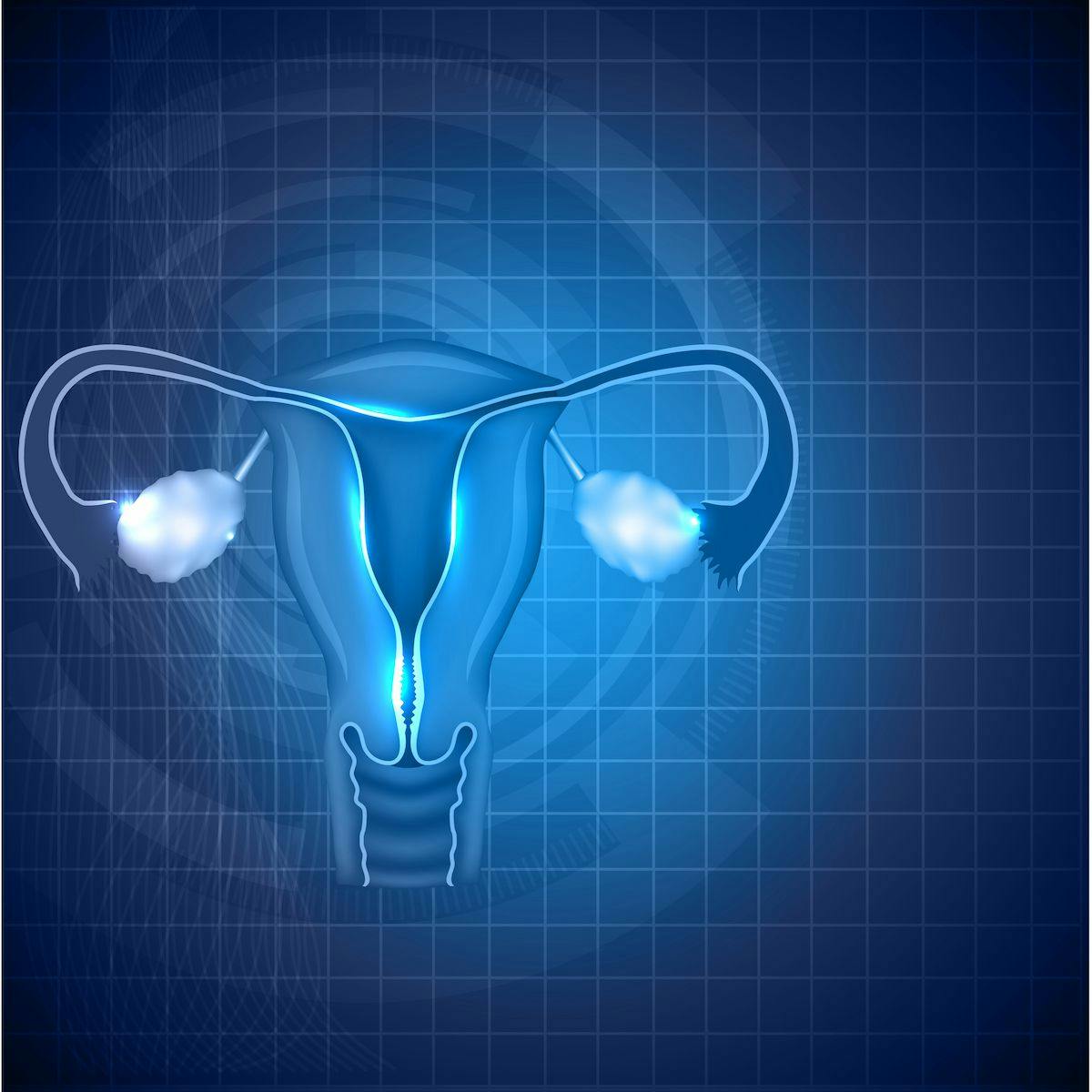 A survival benefit was observed in patients with advanced or recurrent endometrial cancer when treated with maintenance selinexor. 