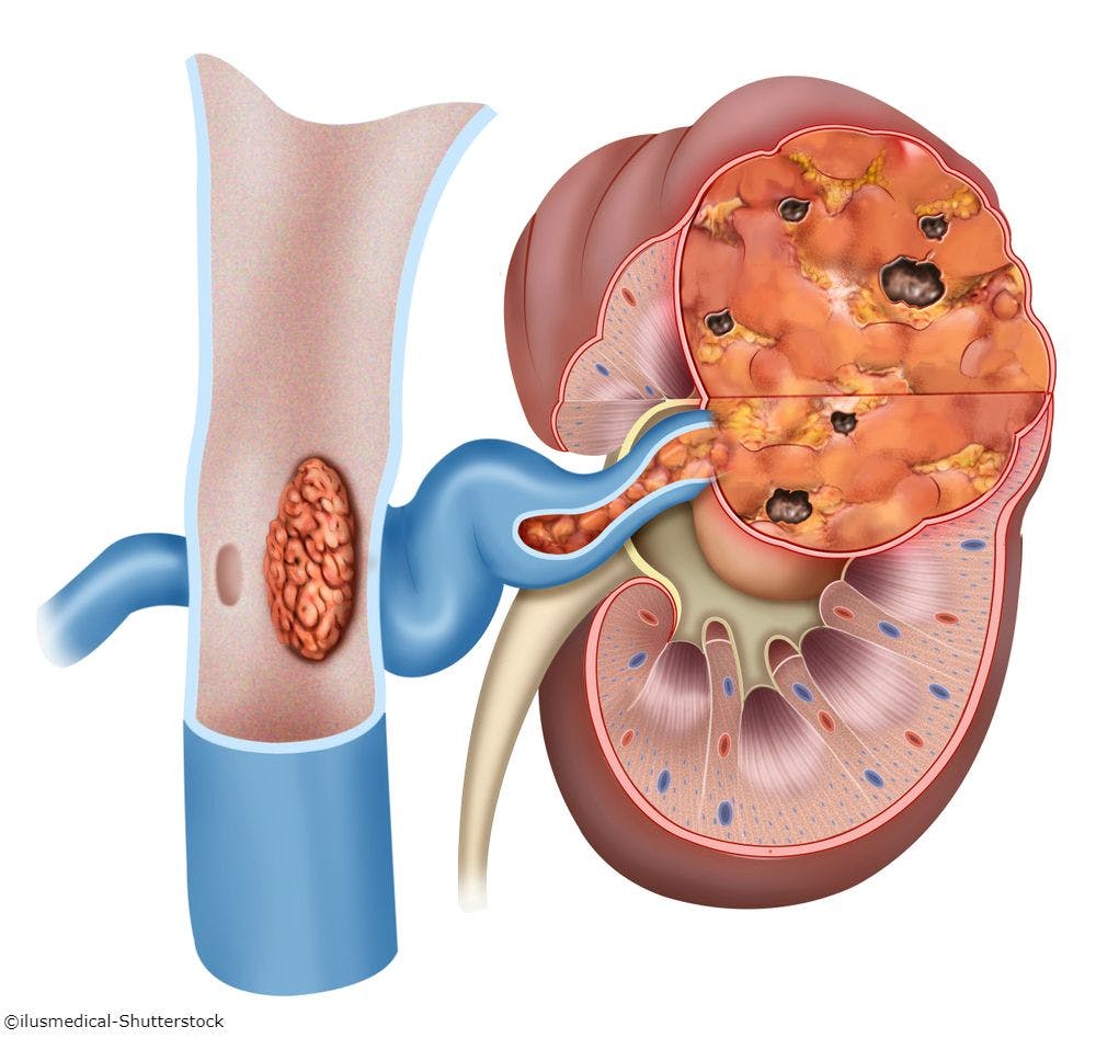 Partial Nephrectomy Linked to Improved OS in T1a RCC