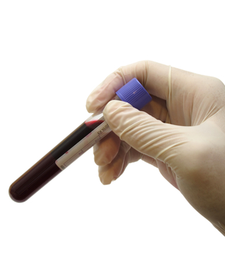 Blood Draw Predicts Resistance to Prostate Cancer Therapy