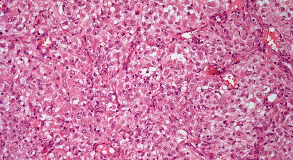 Peritoneal Nodules Found in 53-Year-Old Patient