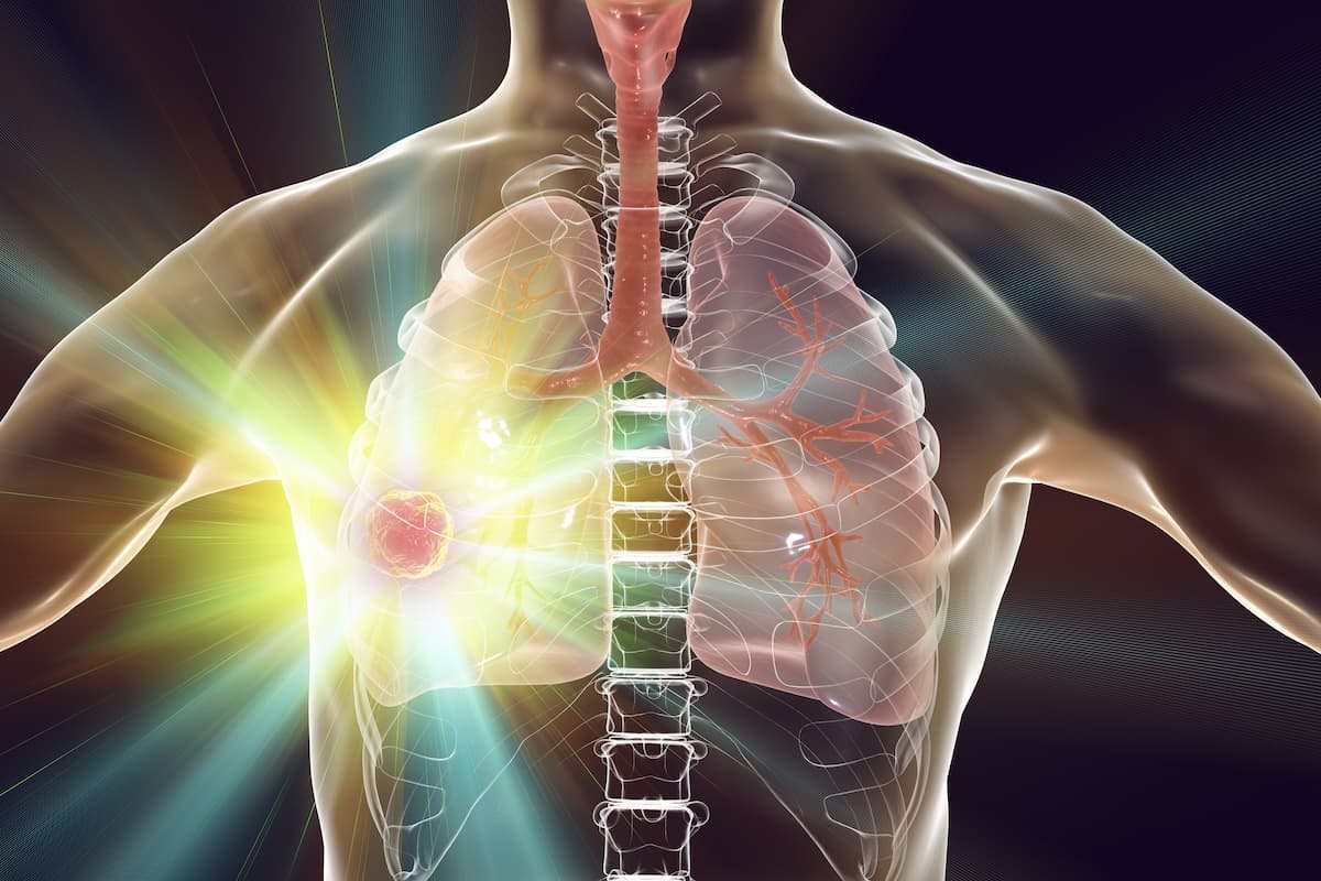 The FDA approved neoadjuvant pembrolizumab plus chemotherapy followed by adjuvant pembrolizumab for patients with resectable NSCLC in October 2023.